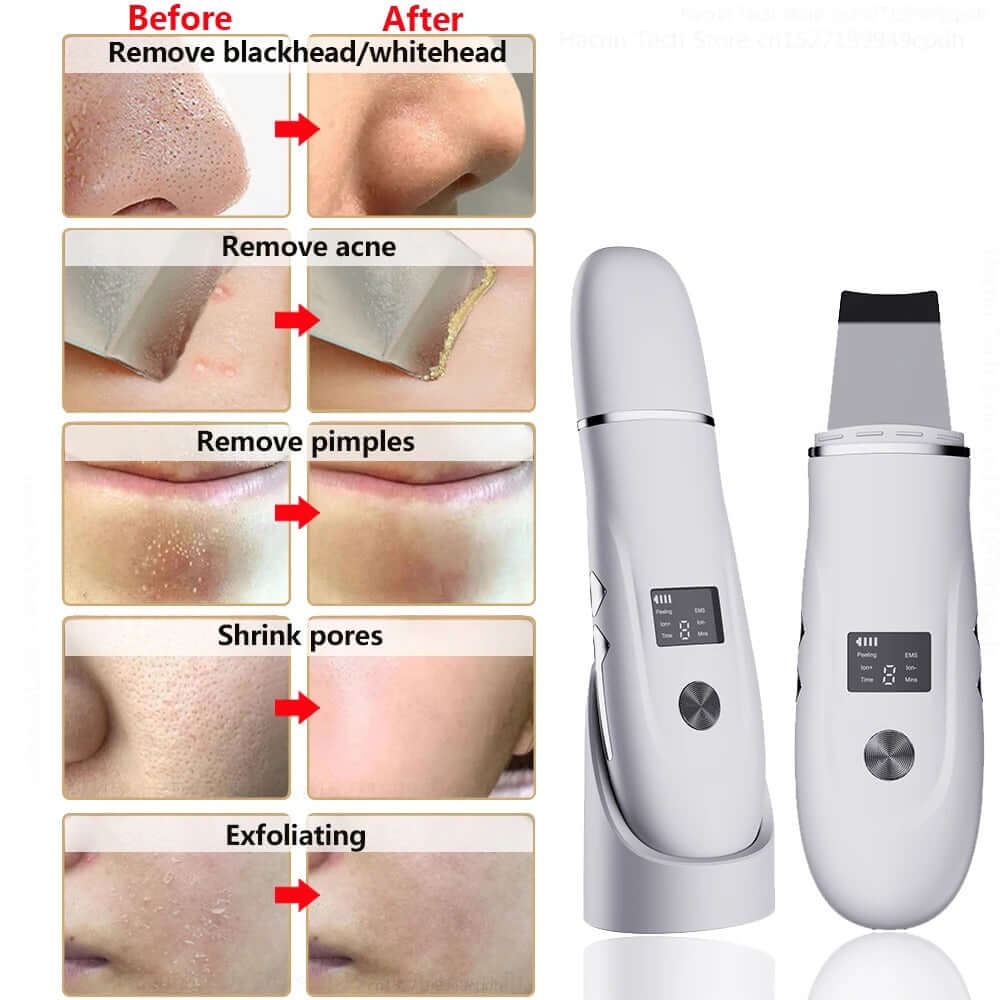 Ultrasonic Skin Scrubber & Blackhead Remover