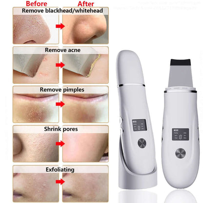 Ultrasonic Skin Scrubber & Blackhead Remover